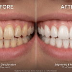 Professional Whitening in Dubai