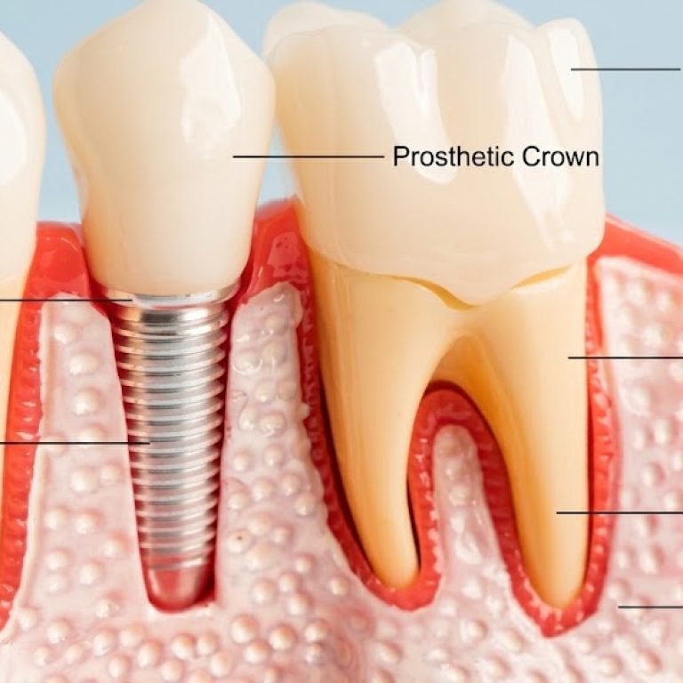 Dental Implant Component 1